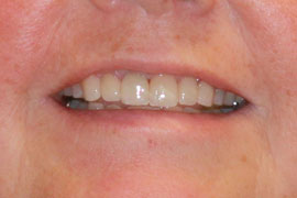 Crown Lengthening & Ceramic Crowns