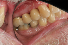 After Implant and Crown