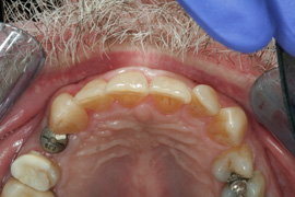 Before Implant and Crown