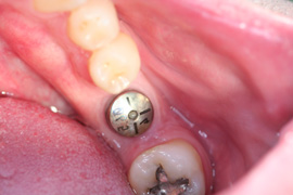 Before Single Implant