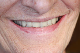 Implant-Retained Overdenture