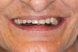 Worn Out Denture