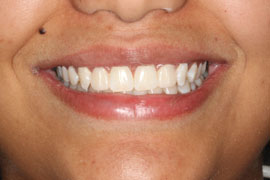 After Bonded Composite Veneers