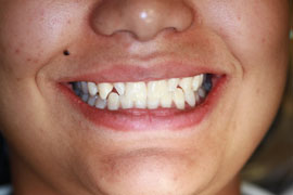 Before Bonded Composite Veneers