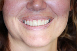 After Bonded Composite Veneers