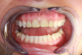 Discolored Composite Veneers