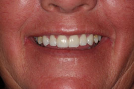 After Veneers